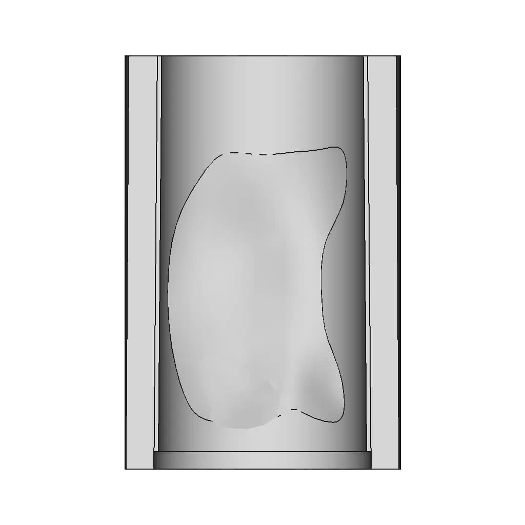 Atherosclerosis Visualization | High-Quality CAD Model_270_0_degree_snapshot