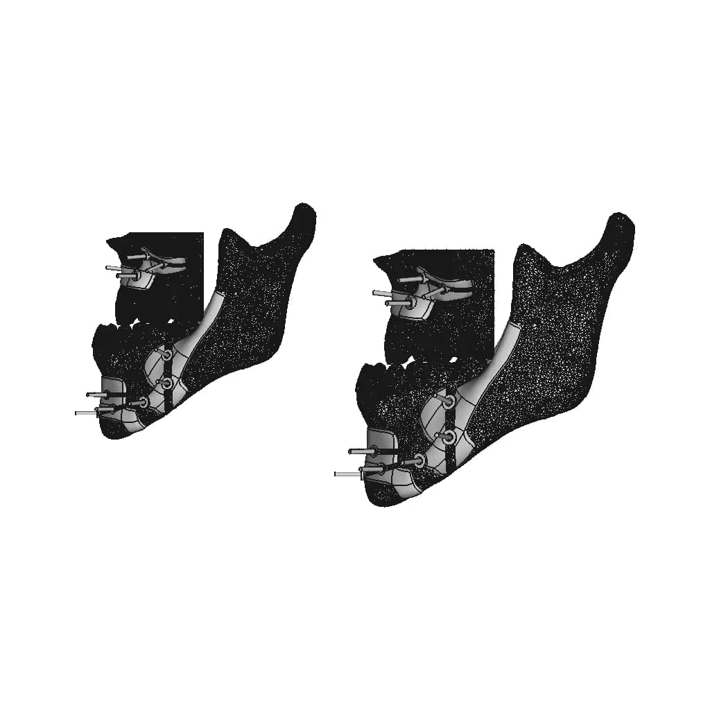 Guiders For Jaws Osteotomy - Downloadable CAD Representation_0_90_degree_snapshot