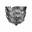 Eye Orbit Prosthetic | High-Quality CAD Model_270_0_degree_snapshot